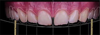imagen de dientes alineados