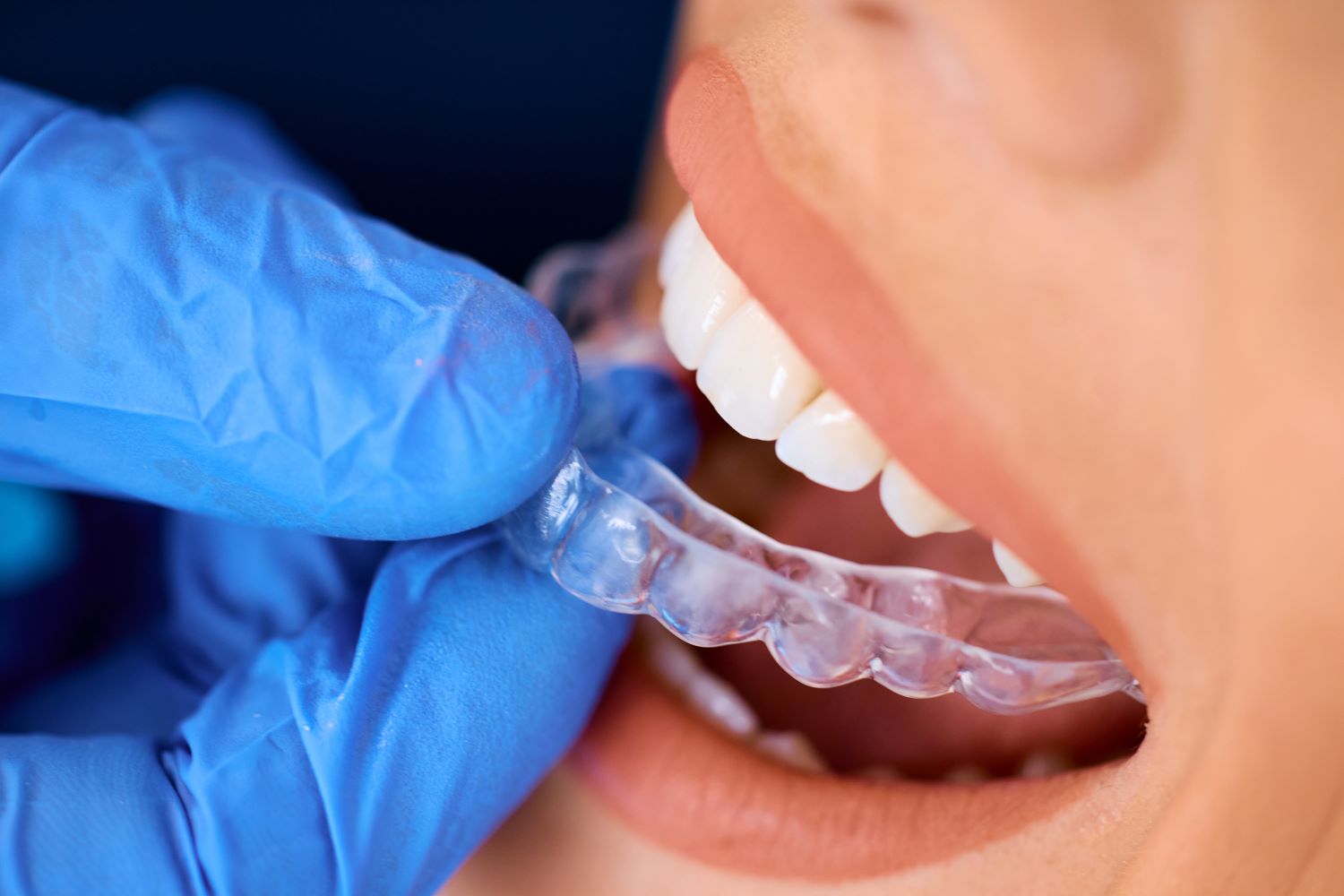 prueba de ferula dental a paciente