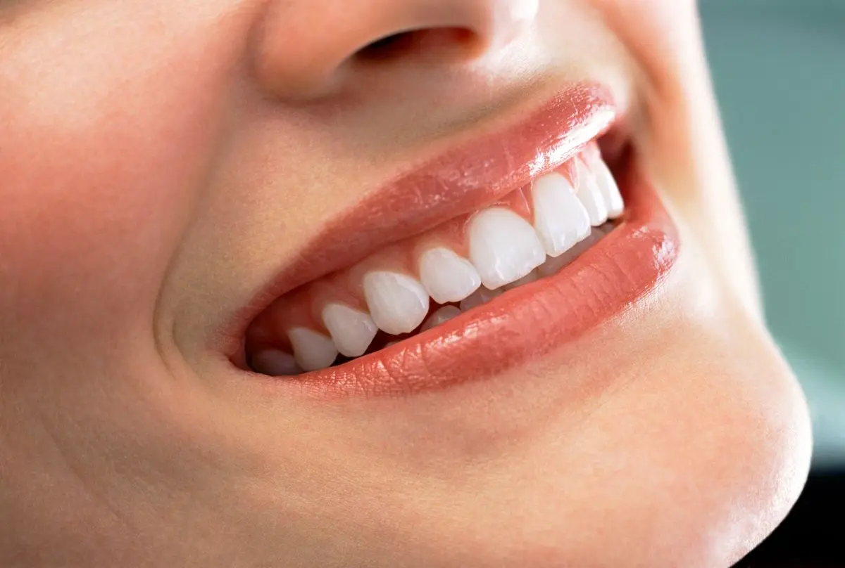 Resultados de estética dental con dentista en Pulianas
