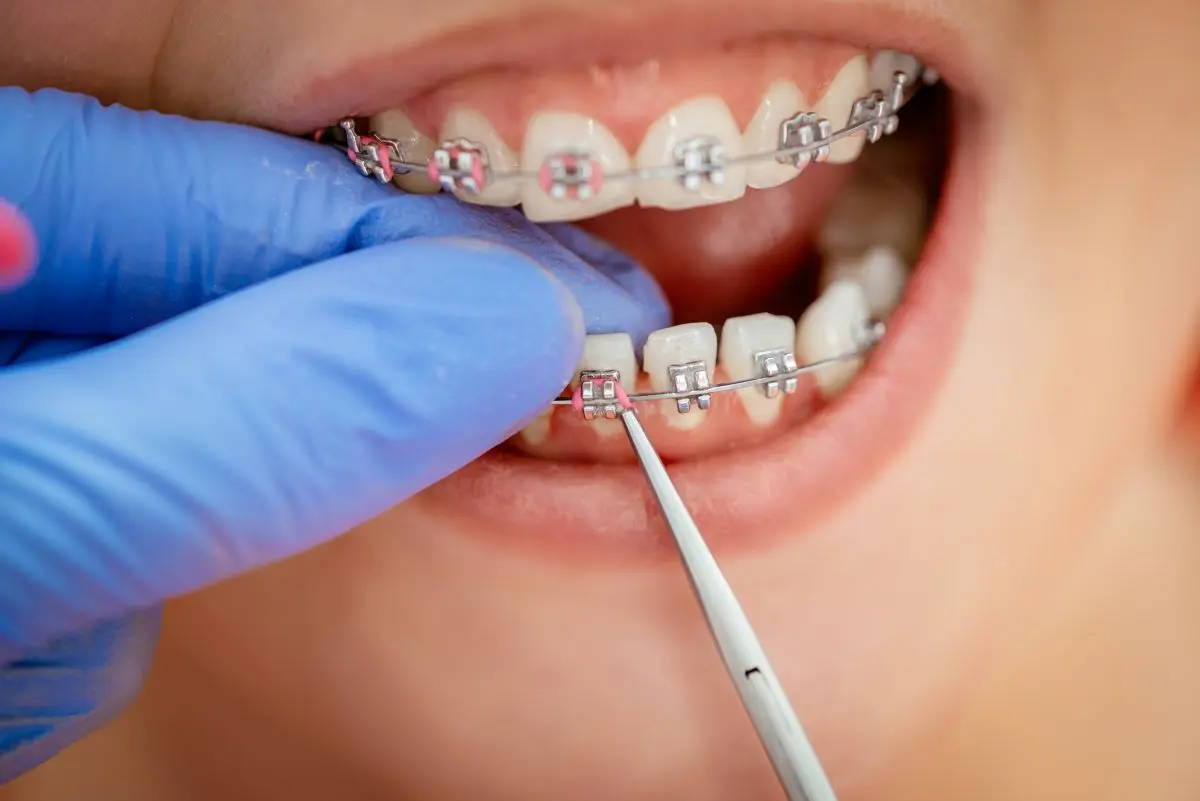 Tratamiento de ortodoncia con brackets metálicos